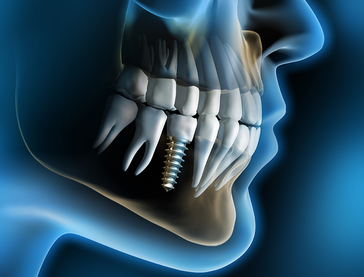 Dental_Implant2